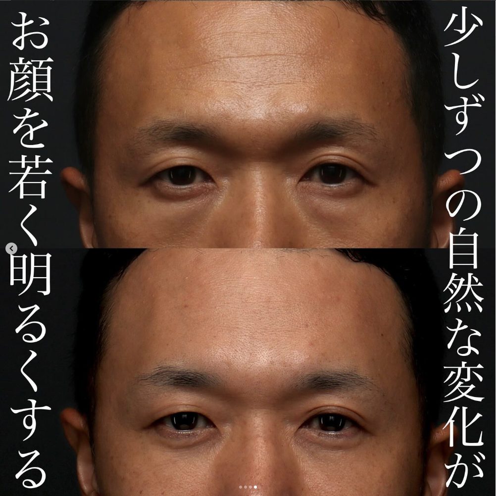 目の下の手術+注入治療の症例(治療前後の写真)