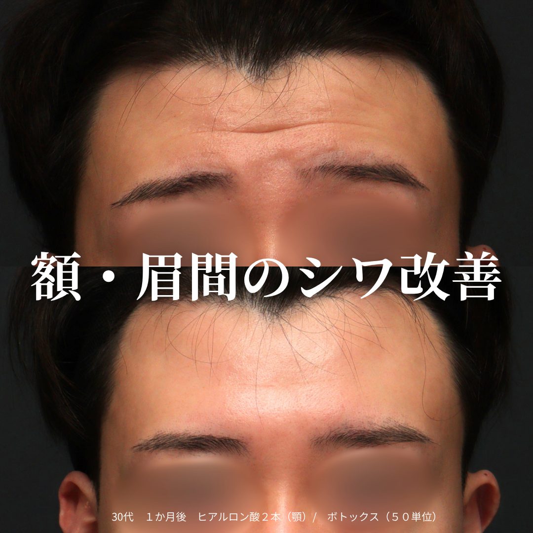 額：治療前（上）と治療1ヶ月後（下）