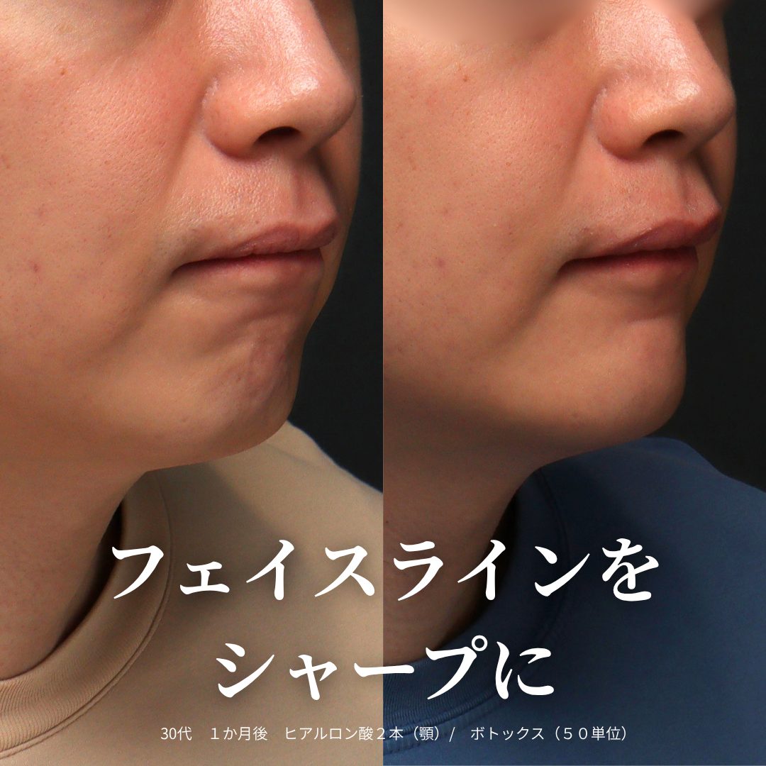 横顔：治療前（左）と治療1ヶ月後（右）
