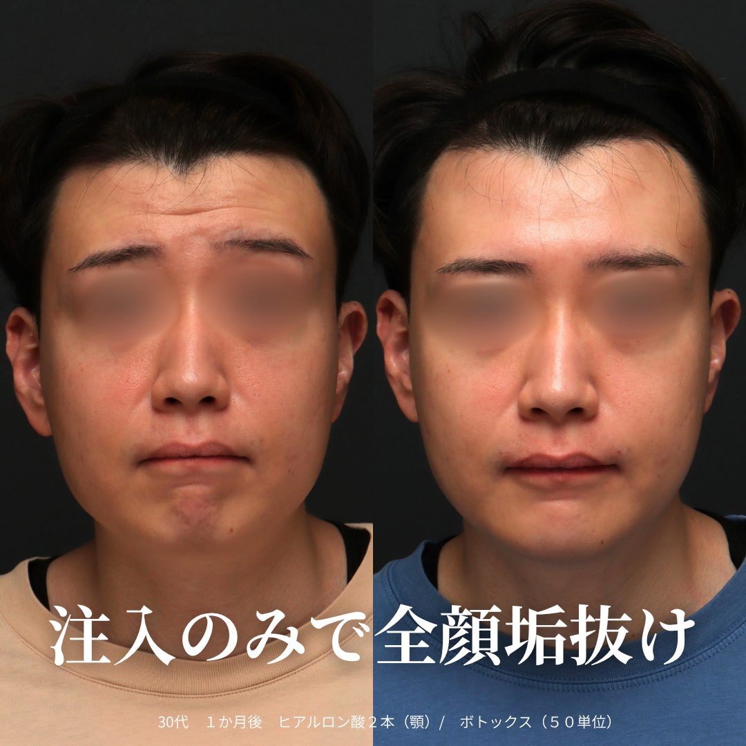 正面：治療前（左）と治療1ヶ月後（右）