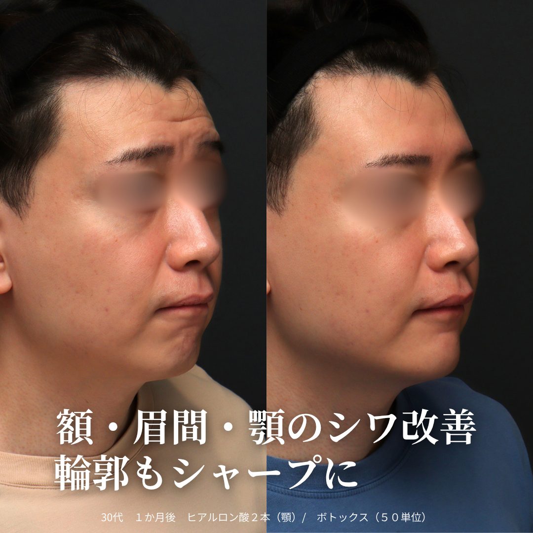 ヒアルロン酸注射（あご）、ボトックス注射（額）の症例（治療前後の写真）
