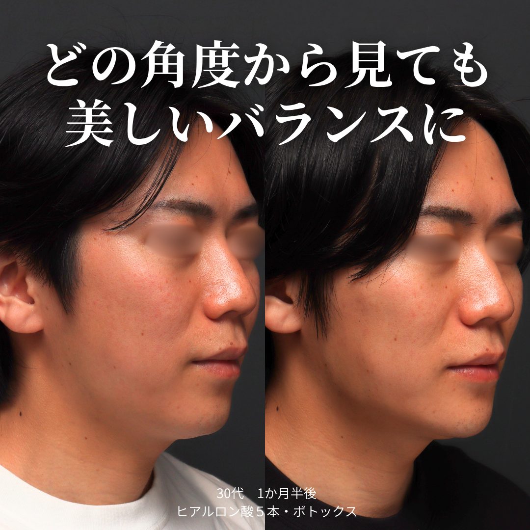 斜め：治療前（左）と治療1ヶ月半後（右）