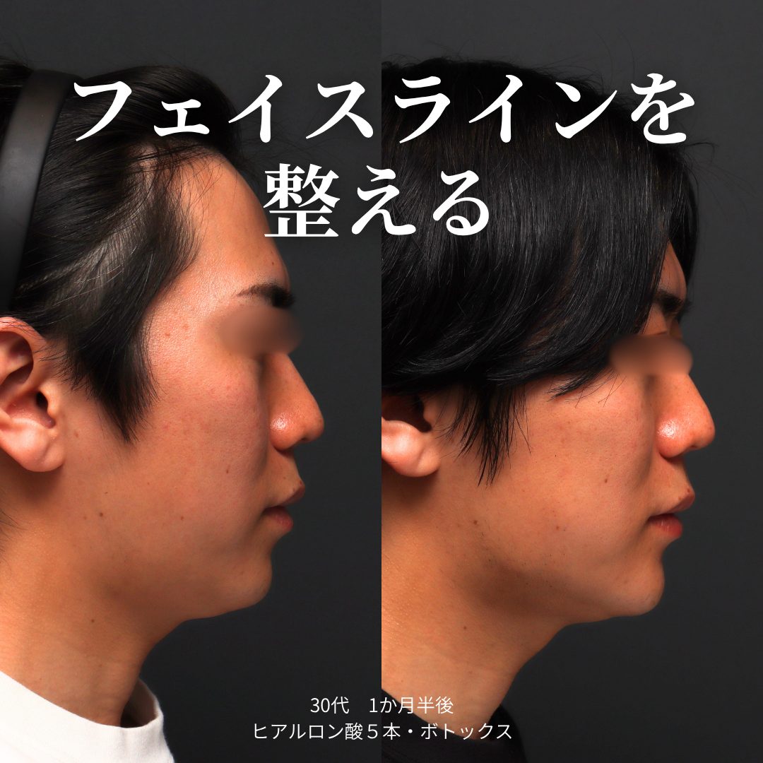 横顔：治療前（左）と治療1ヶ月半後（右）