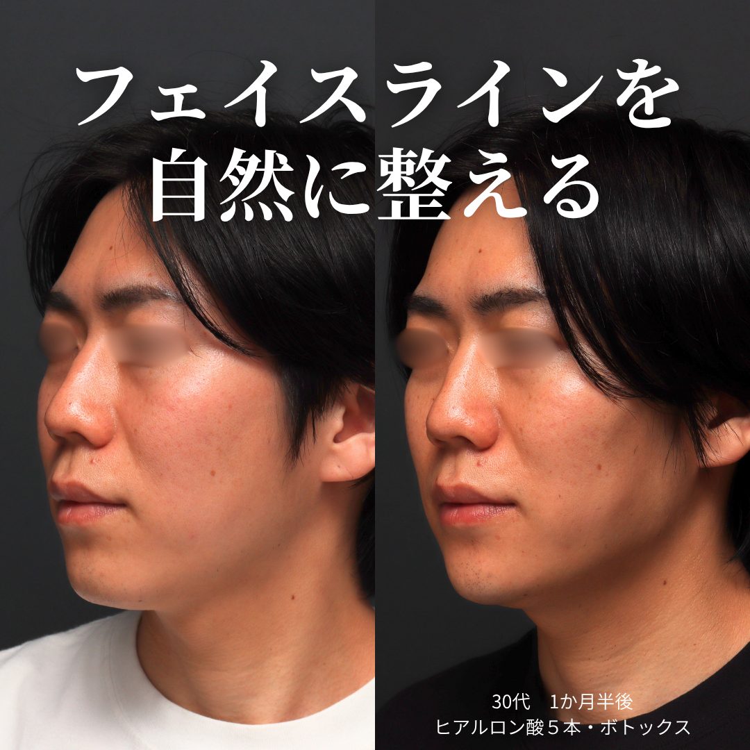 ヒアルロン酸注射、ボトックス注射の症例（治療前後の写真）