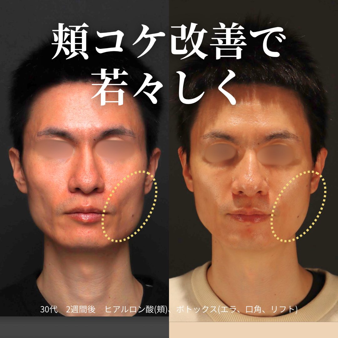 ヒアルロン酸注射（頬）、ボトックス注射の症例（治療前後の写真）