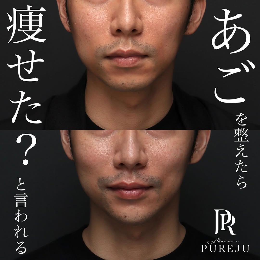 ヒアルロン酸注射(あご)の症例(治療前後の写真)