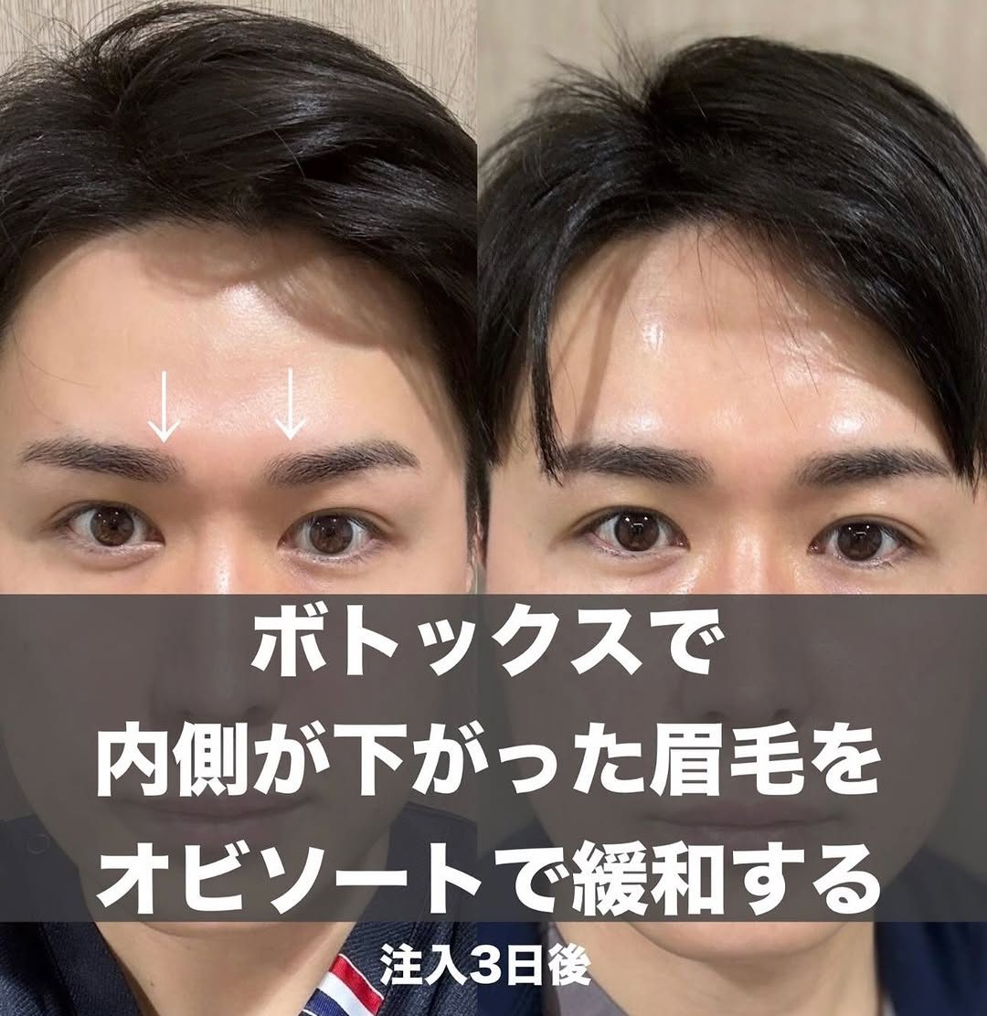 ボトックス調整(オビソート+KOライト)の症例(治療前後の写真)