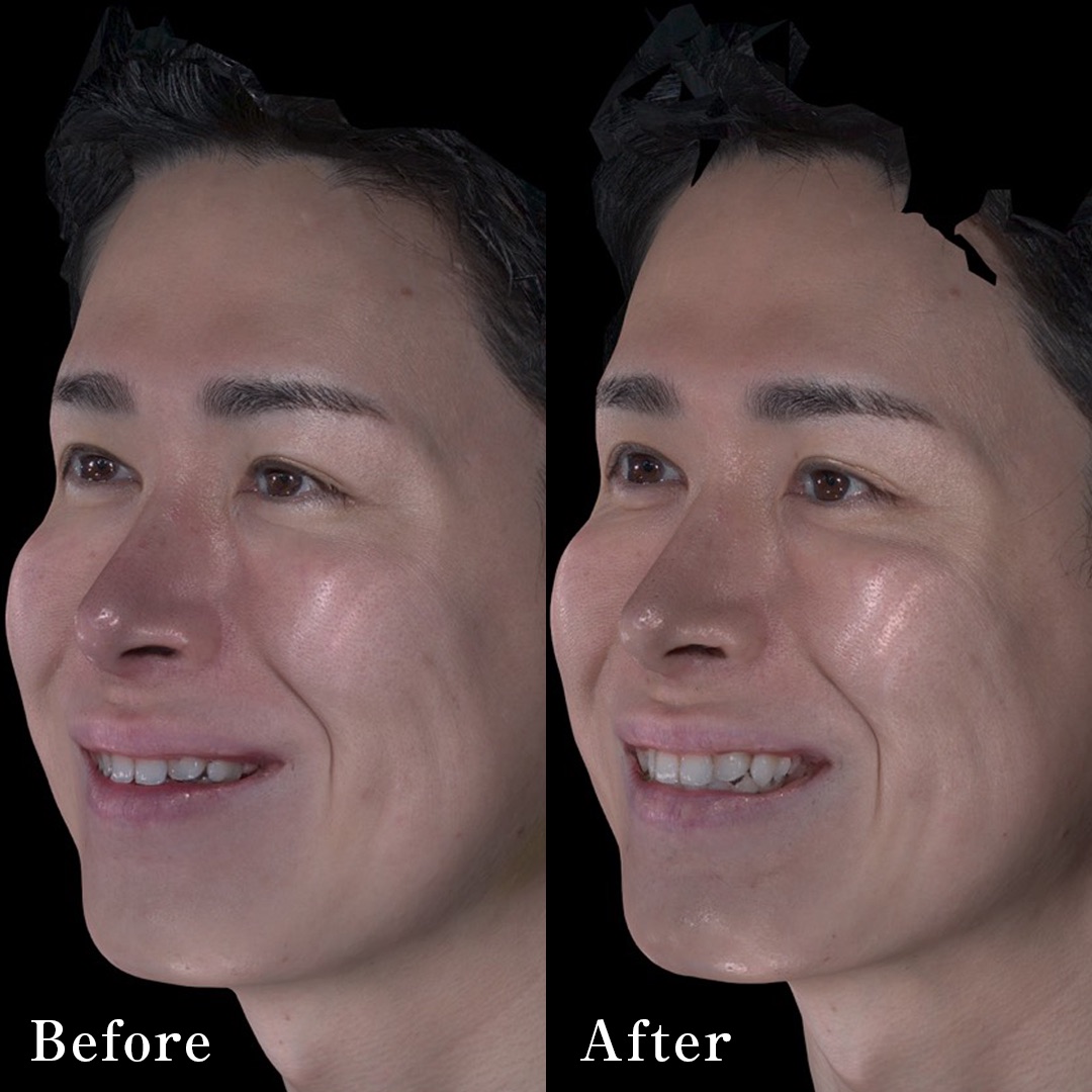 eM Lift（イーエムリフト）の症例（治療前後の写真）