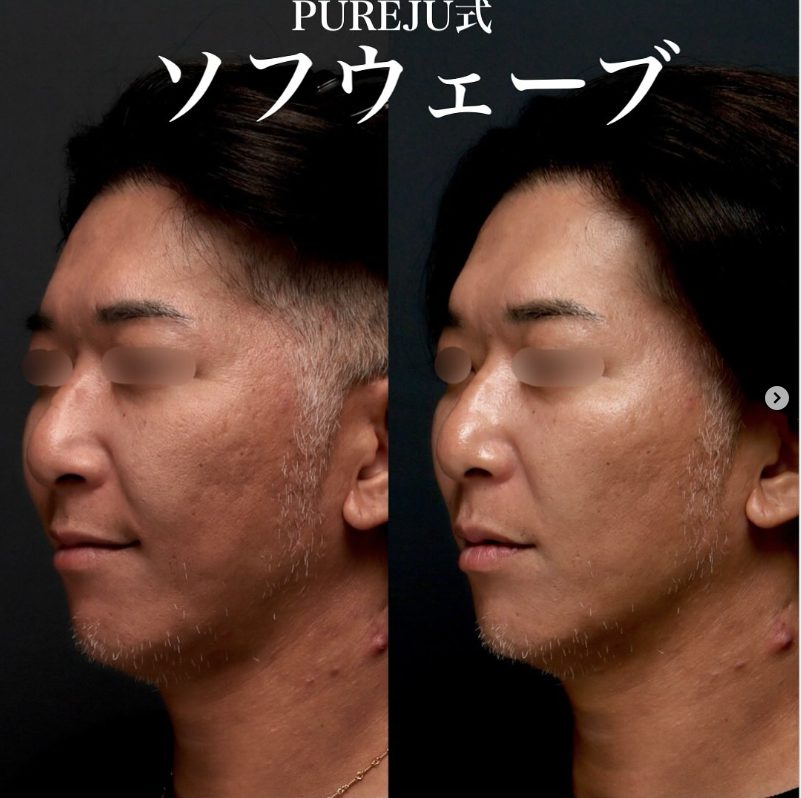 ソフウェーブの症例（治療前後の写真）