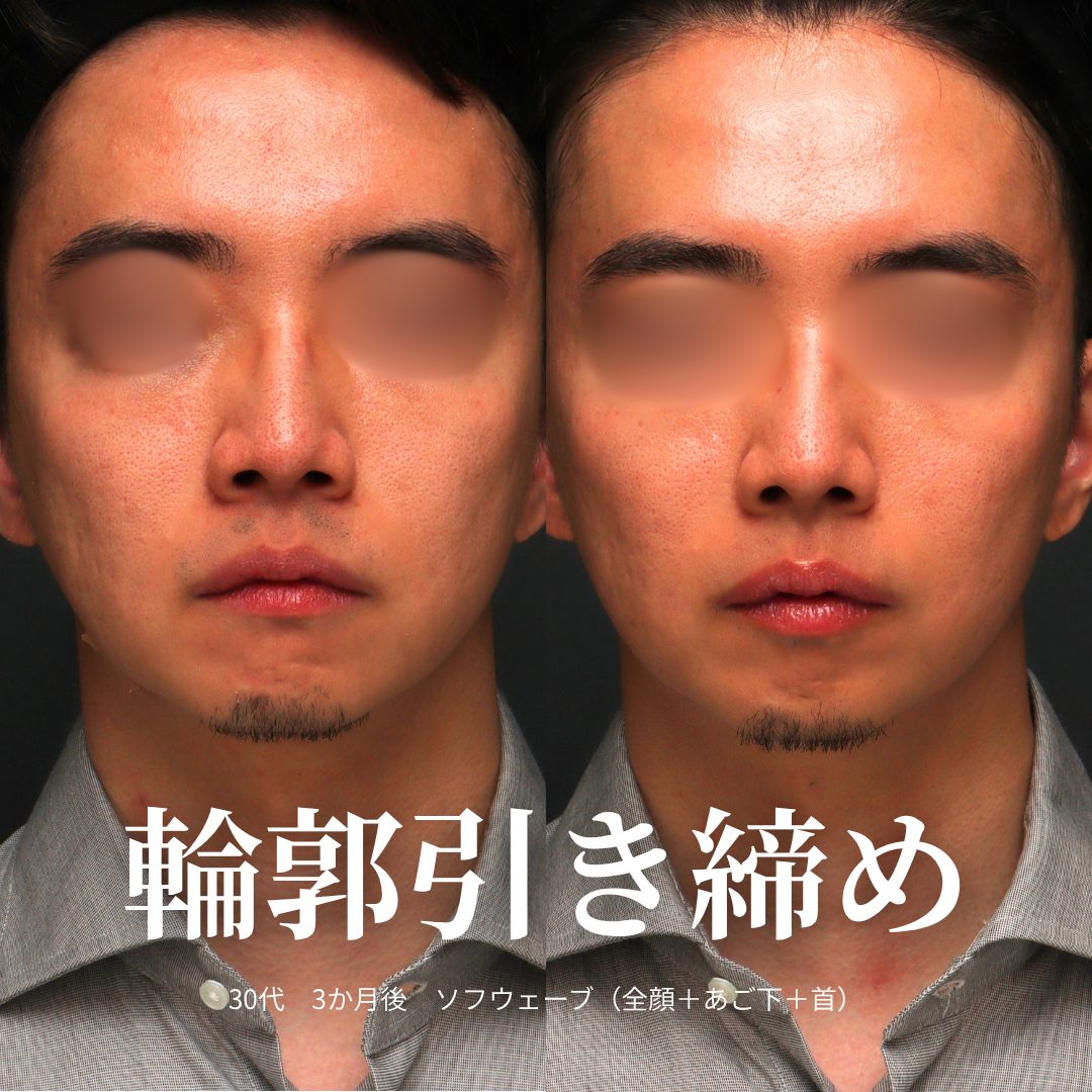 ソフウェーブの症例（治療前後の写真）