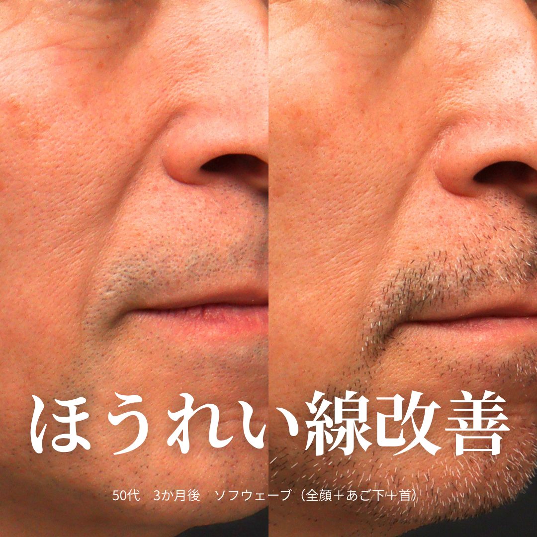 口元の寄り：治療前（左）と治療3ヶ月後（右）