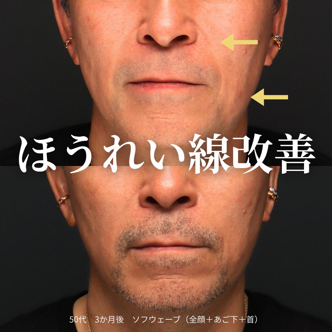 ソフウェーブの症例（治療前後の写真）