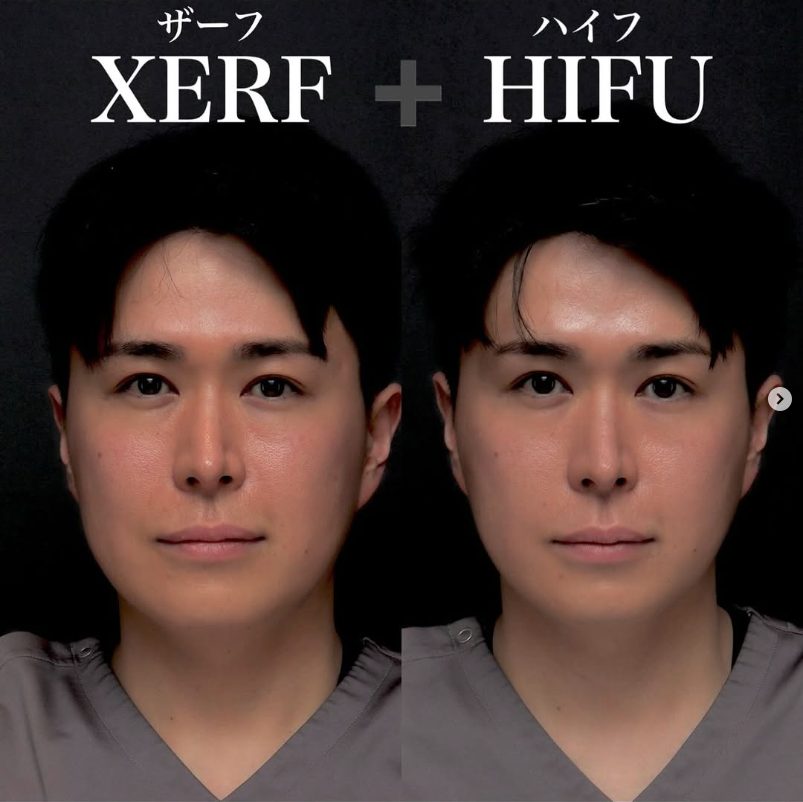 XERF＋HIFUの症例（治療前後の写真）