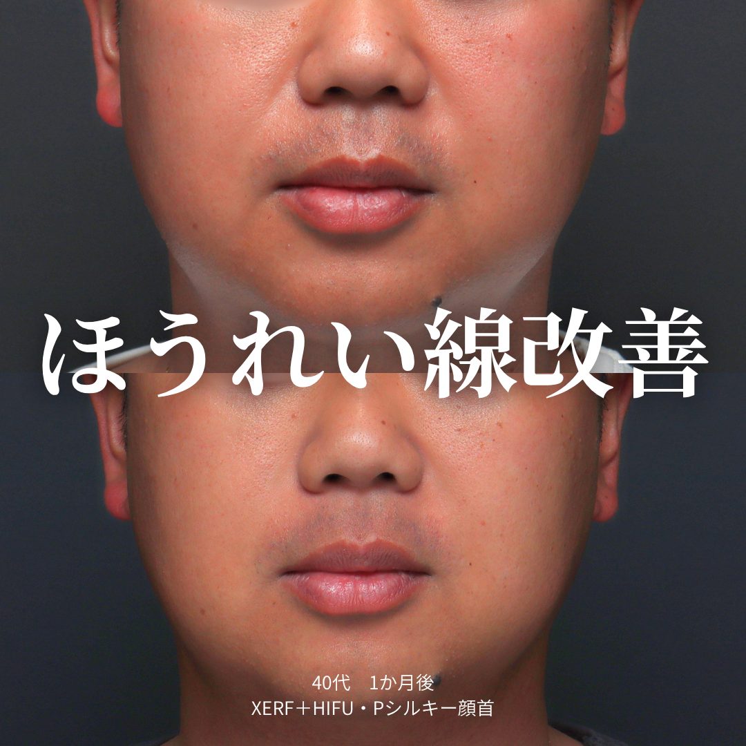 XERF＋HIFU、プレミアムシルキー注射の症例（治療前後の写真）