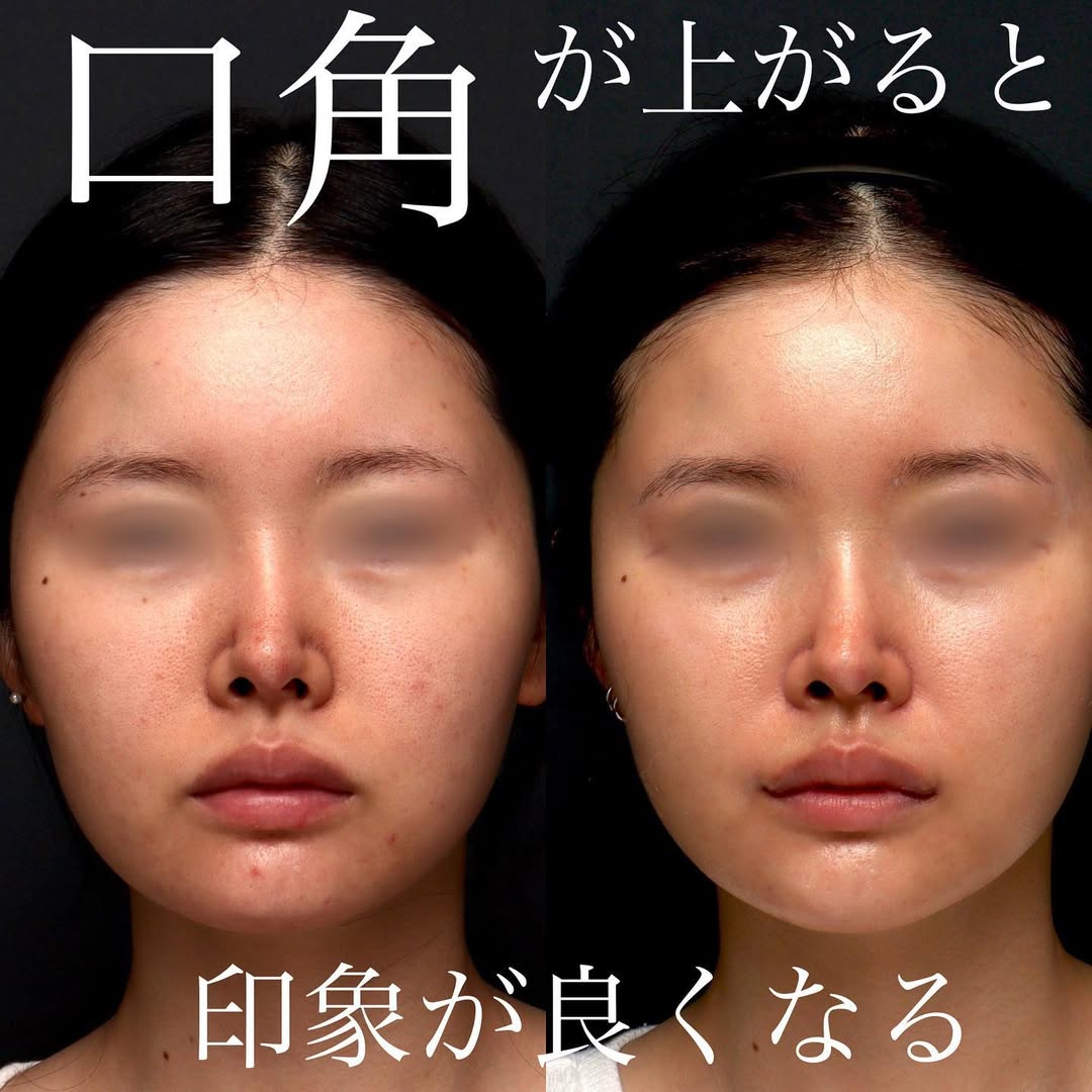 口角挙上の症例(ビフォーアフター)