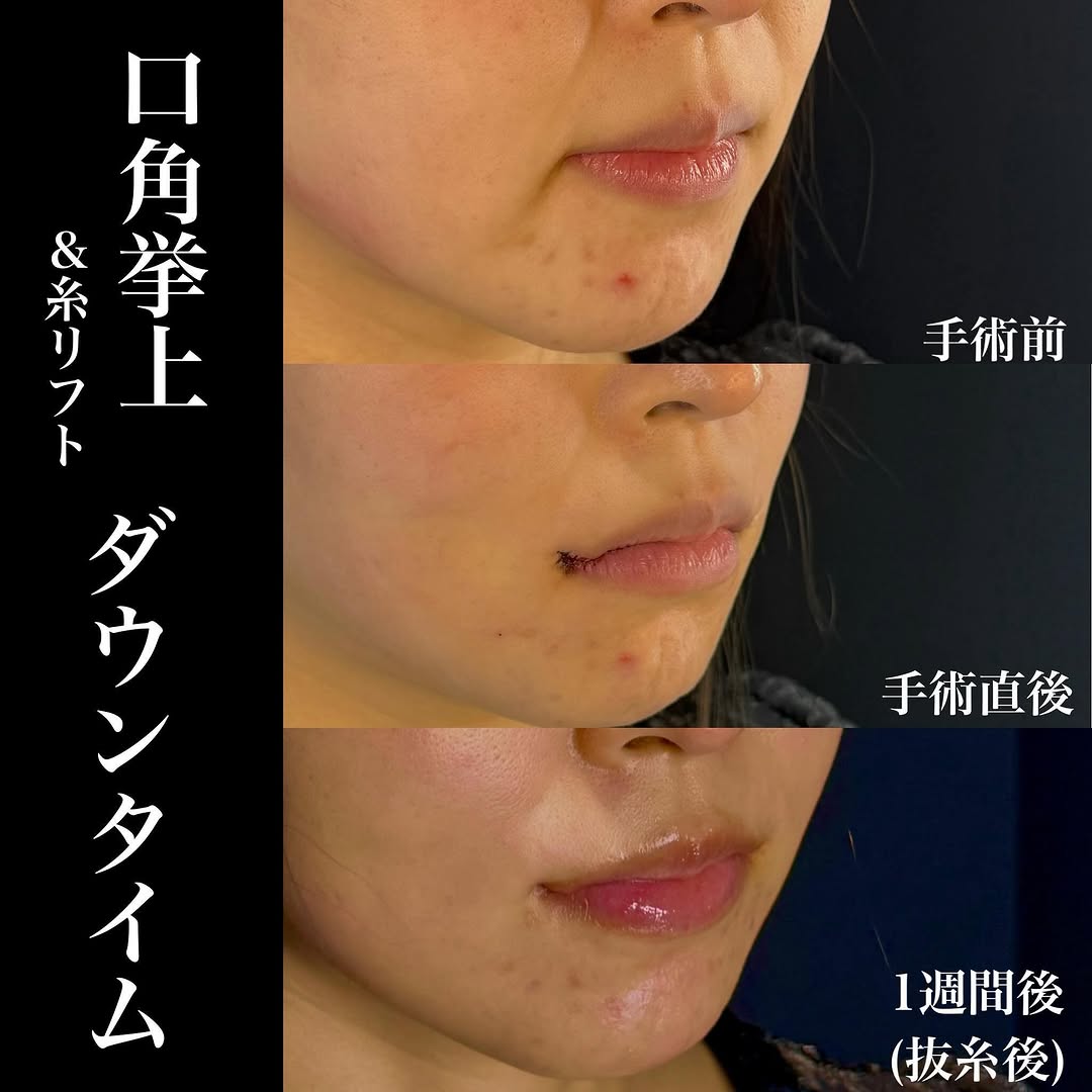 口角挙上の症例(ビフォーアフター)