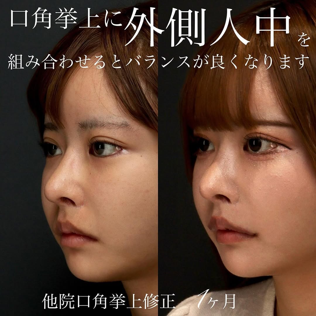 口角挙上の症例(ビフォーアフター)