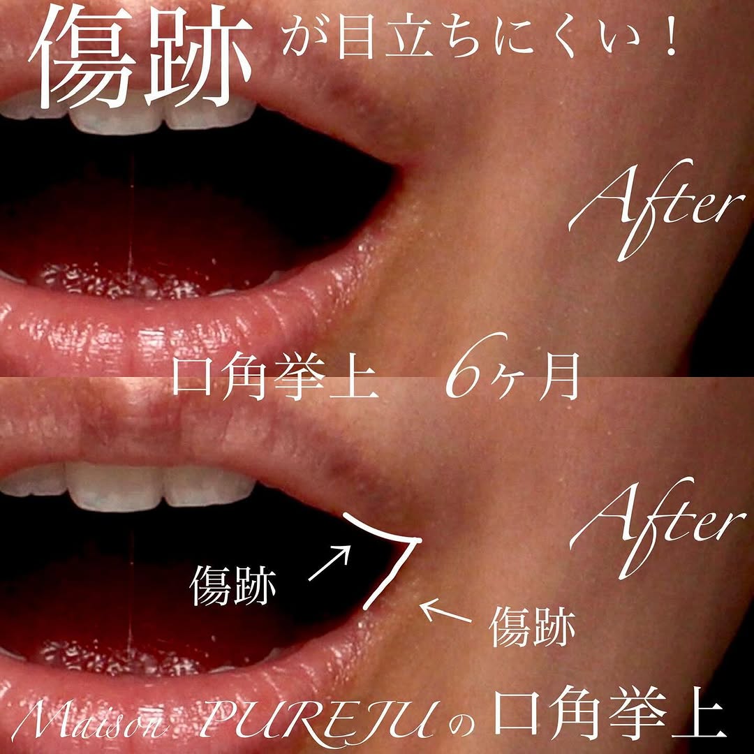 口角挙上の症例(ビフォーアフター)