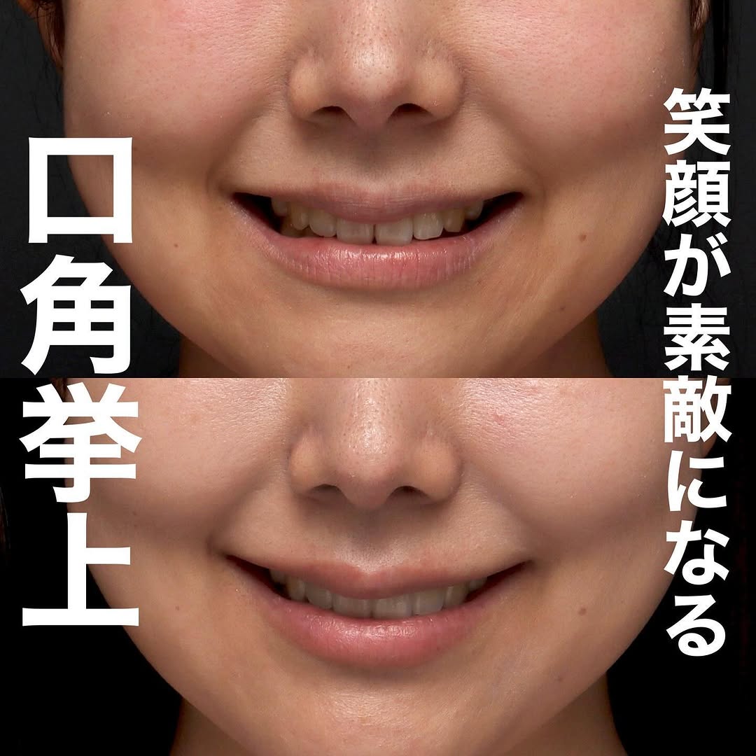 口角挙上の症例(ビフォーアフター)