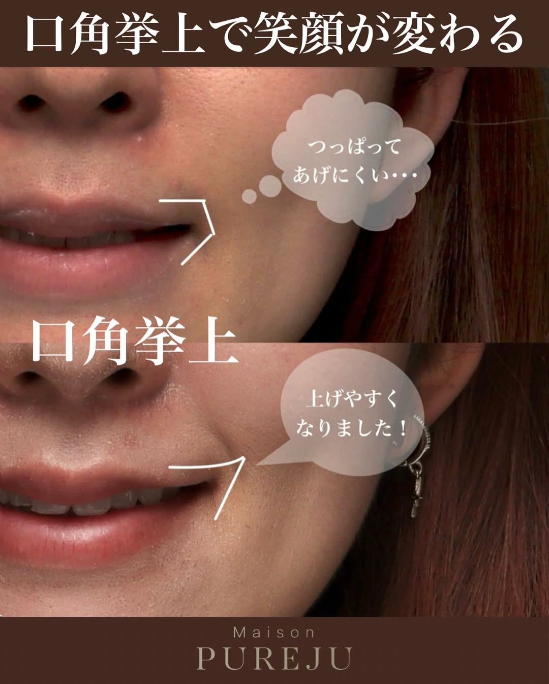 口角挙上の症例(ビフォーアフター)