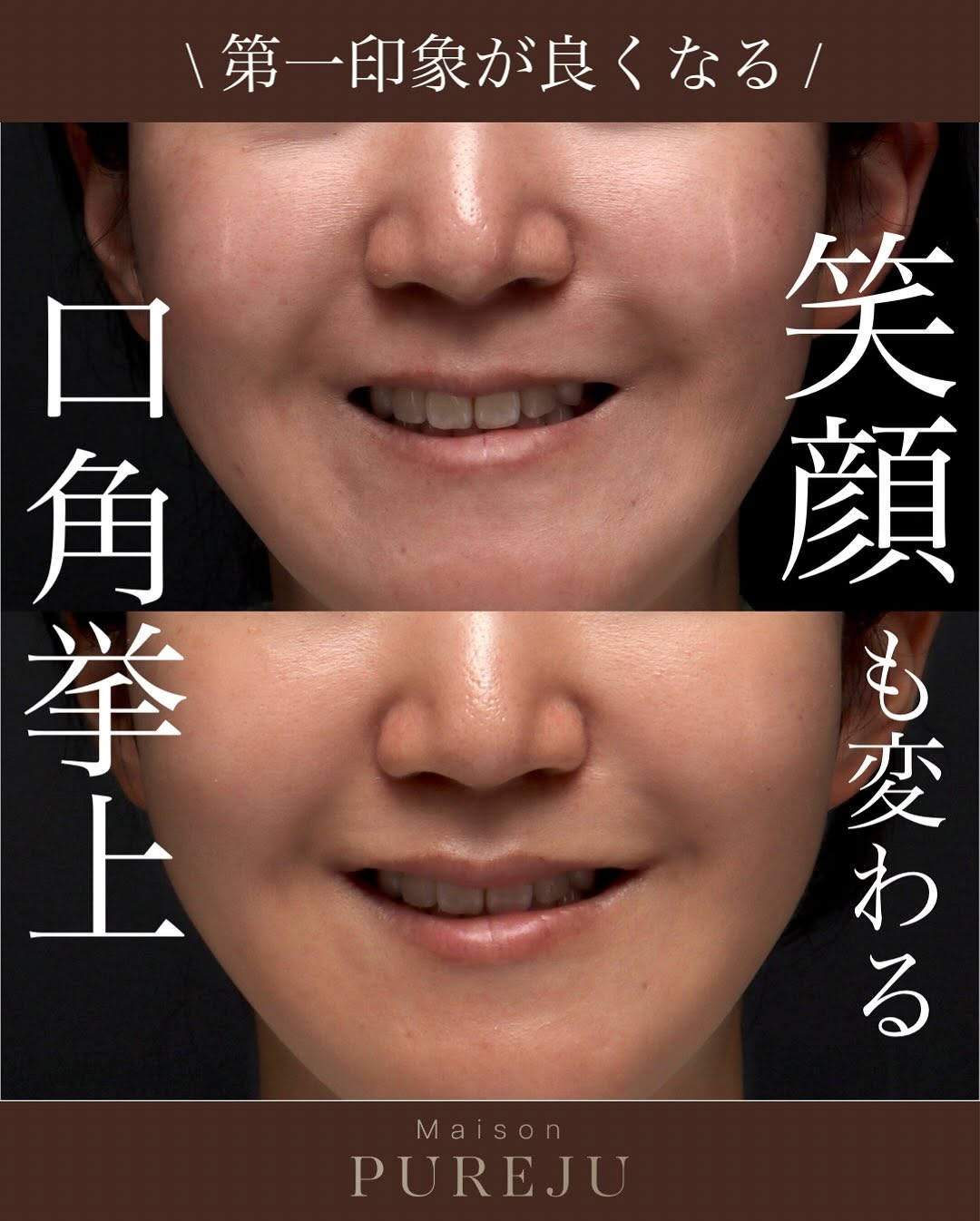 口角挙上の症例(ビフォーアフター)