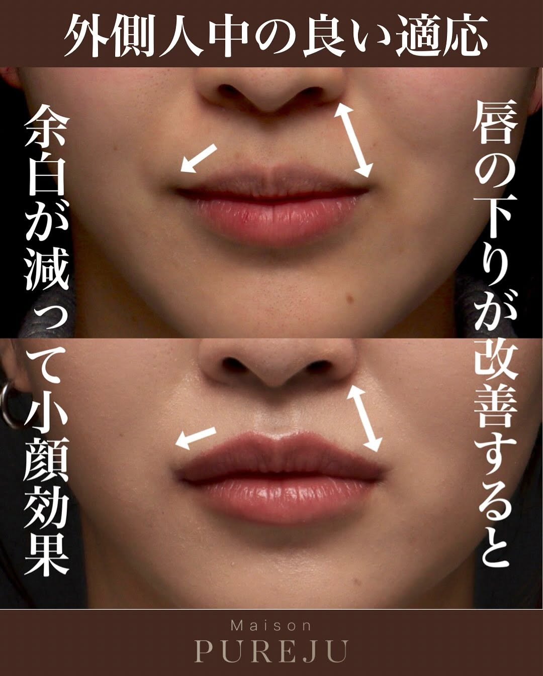 外側人中短縮の症例（ビフォーアフター）