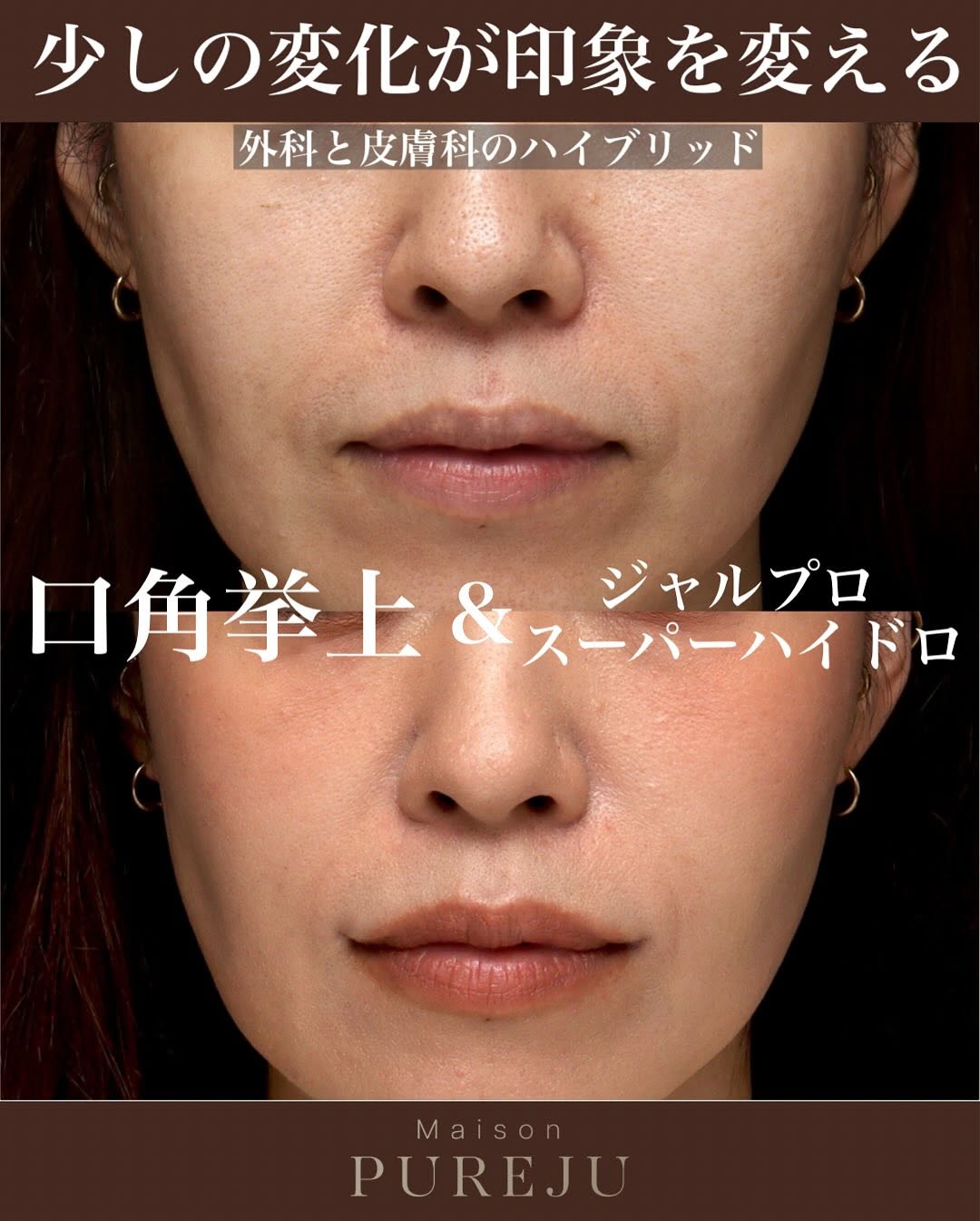 口角挙上の症例(ビフォーアフター)