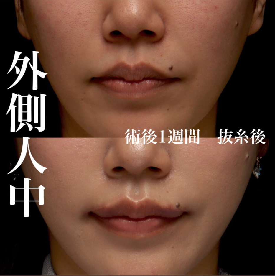 外側人中短縮の症例(ビフォーアフター)
