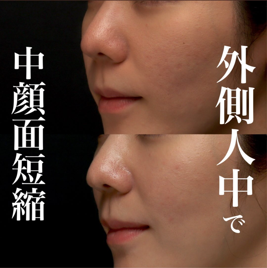 外側人中短縮の症例（ビフォーアフター）