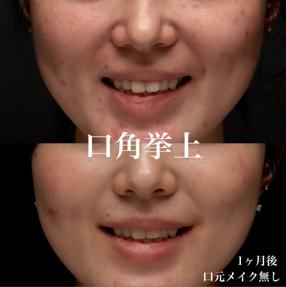 口角挙上の症例(ビフォーアフター)