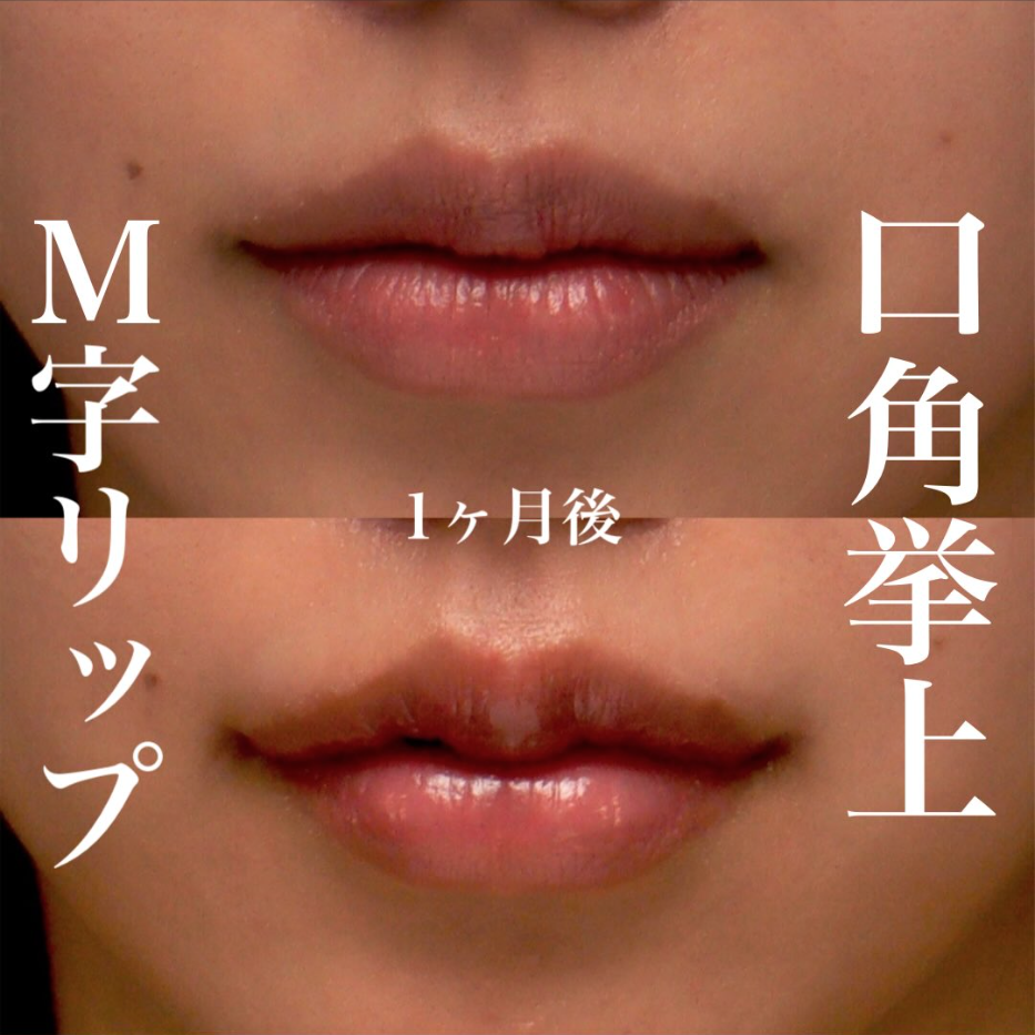 M字リップ+口角挙上の症例(ビフォーアフター)
