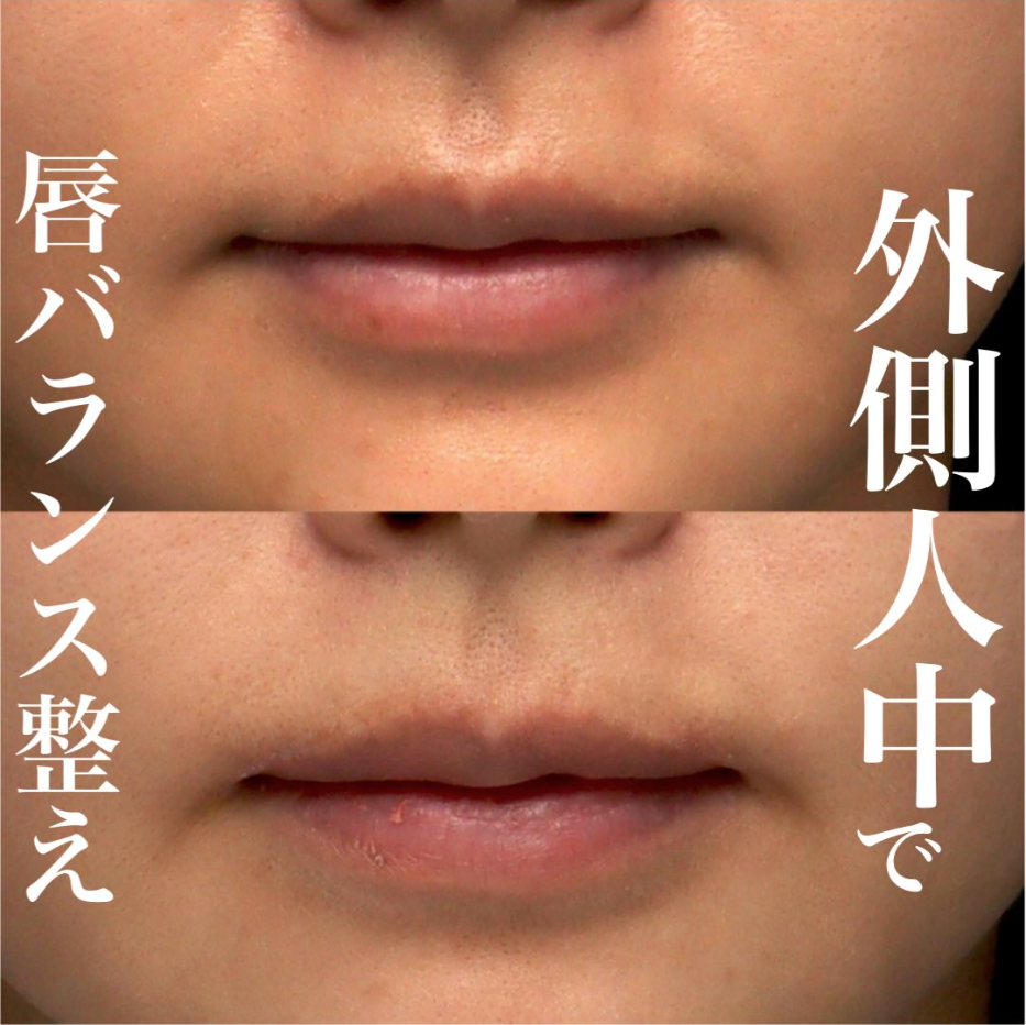 外側人中短縮の症例（ビフォーアフター）