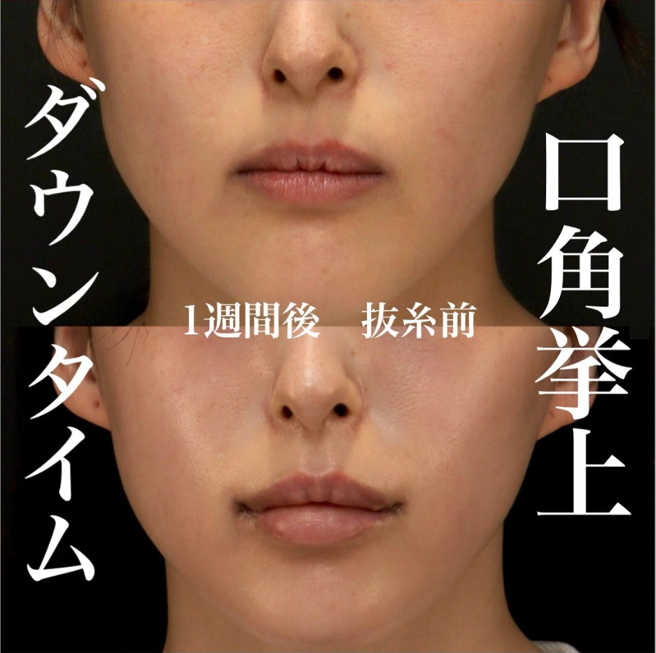 口角挙上の症例(ビフォーアフター)