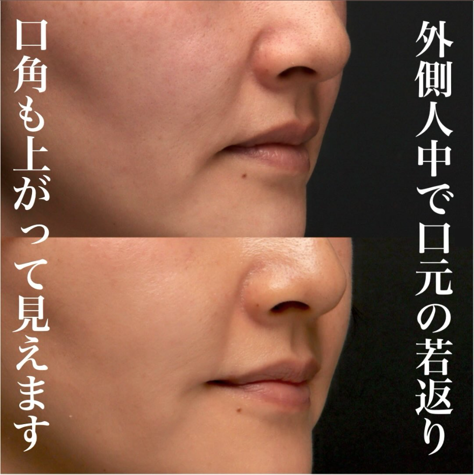 外側人中短縮の症例（ビフォーアフター）