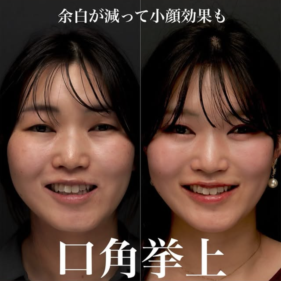 口角挙上の症例(ビフォーアフター)