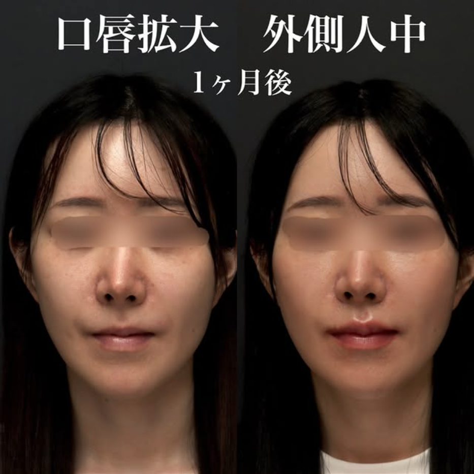 口唇拡大+外側人中短縮の症例(ビフォーアフター)