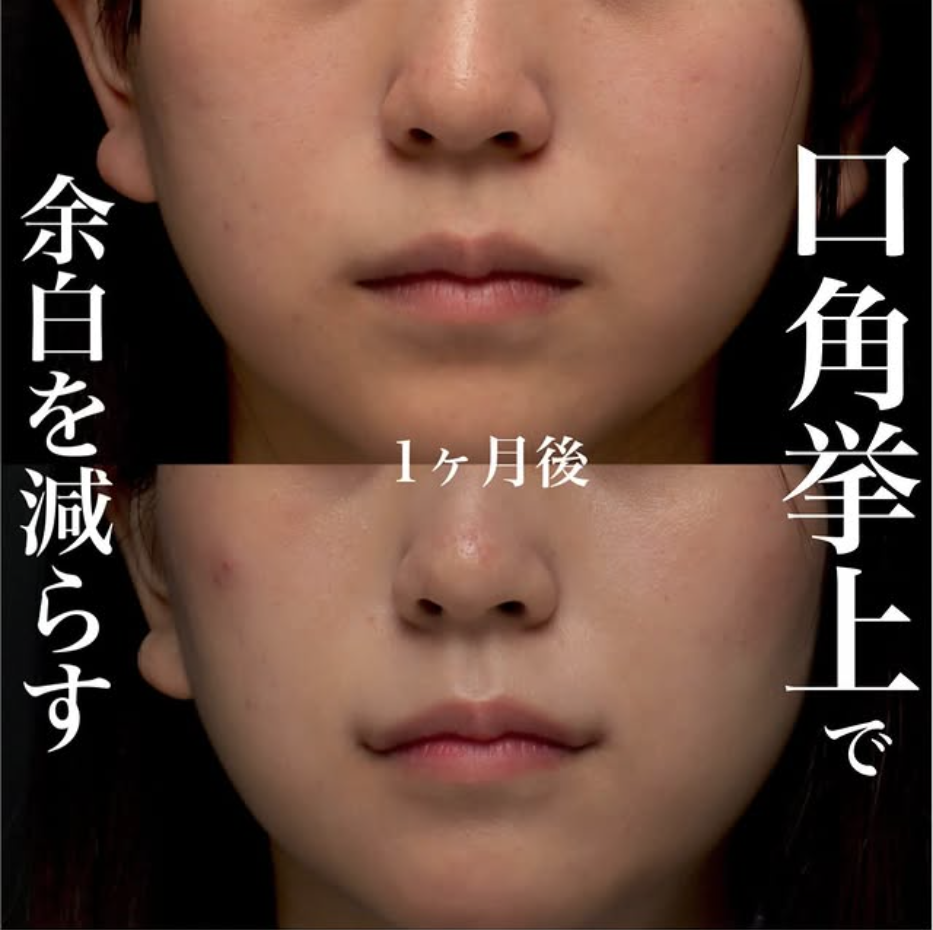 口角挙上の症例(ビフォーアフター)