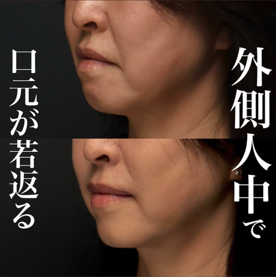 外側人中短縮の症例(ビフォーアフター)