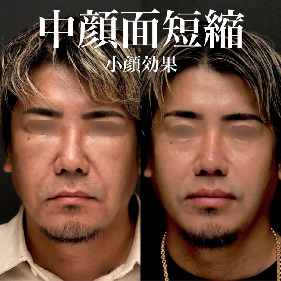 人中短縮＋外側人中短縮の症例（ビフォーアフター）