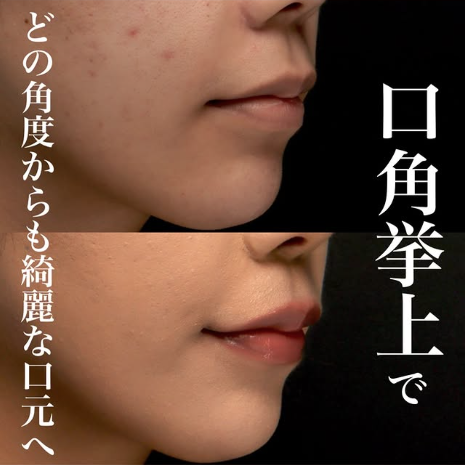 口角挙上の症例(ビフォーアフター)