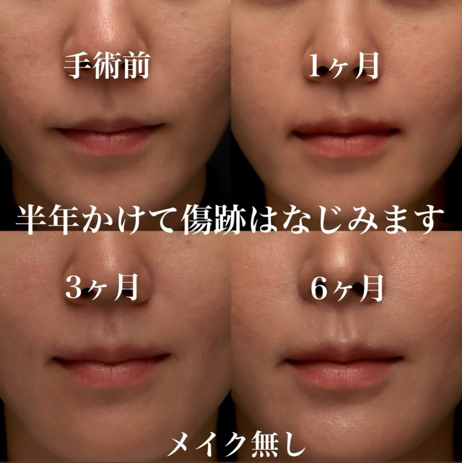 外側人中短縮の症例（ビフォーアフター）