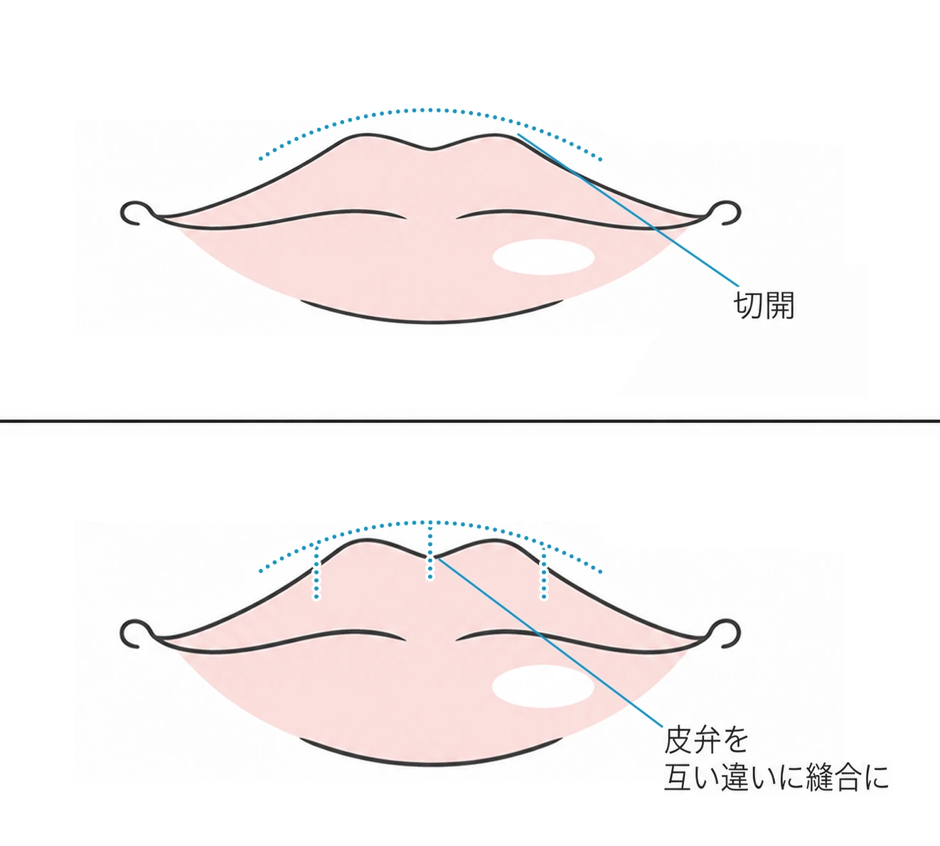 粘膜を切開し、皮弁を互い違いに縫合して厚みを出す口唇拡大の術式を示したイラスト（イメージ）