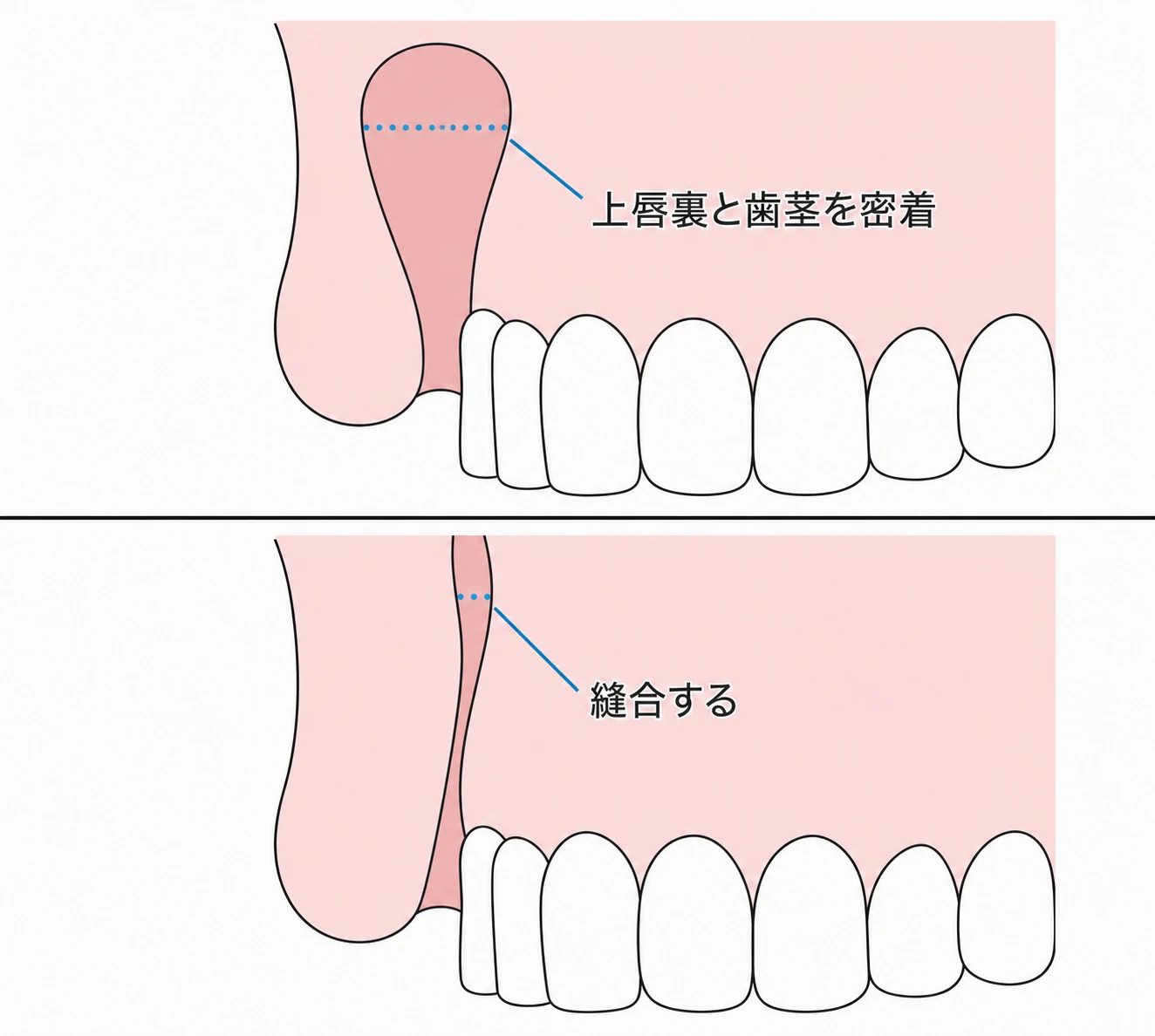 上唇の裏と歯茎を密着させて縫合し、歯ぐきの露出を抑えるガミースマイル手術の術式を示したイラスト（イメージ）