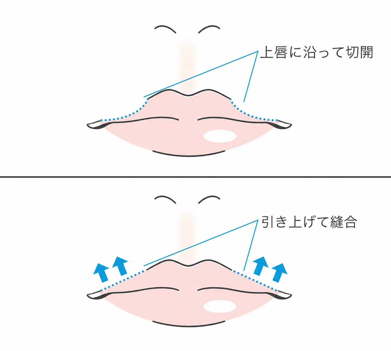 上唇に沿って切開し、外側を引き上げて縫合する外側人中短縮の術式を示したイラスト（イメージ）