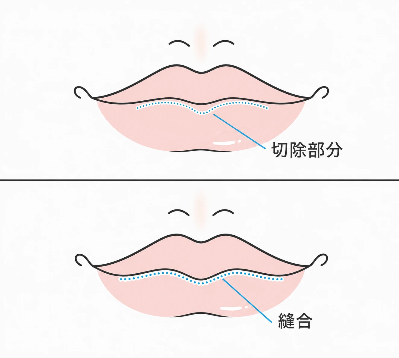 下唇の粘膜を切除し、くびれを作るように縫合するピーナッツリップ形成の術式を示したイラスト（イメージ）