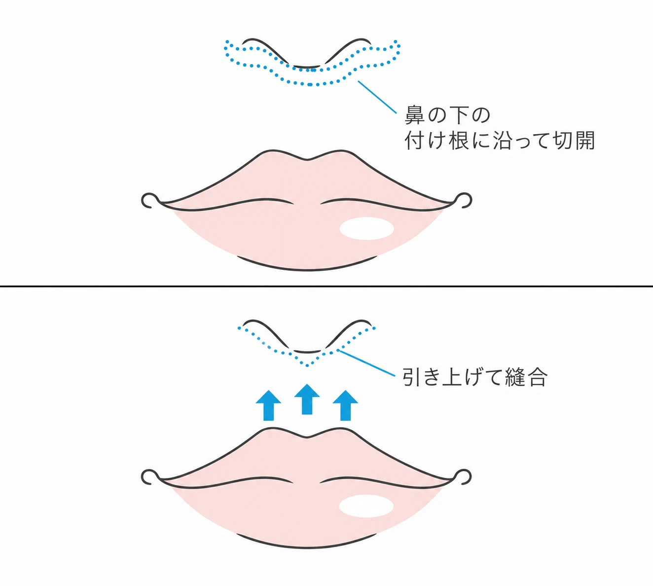 鼻の下の付け根に沿って切開し、引き上げて縫合する人中短縮の術式を示したイラスト（イメージ）
