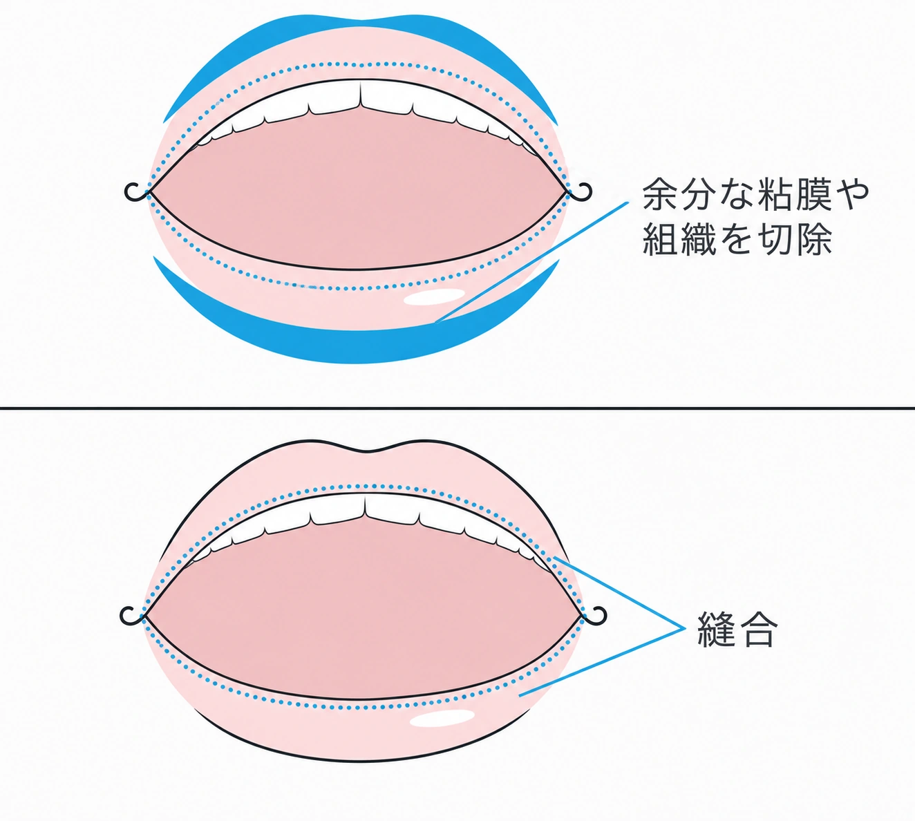 余分な粘膜や組織を切除し、縫合して唇の厚みを整える口唇縮小術の術式を示したイラスト（イメージ）